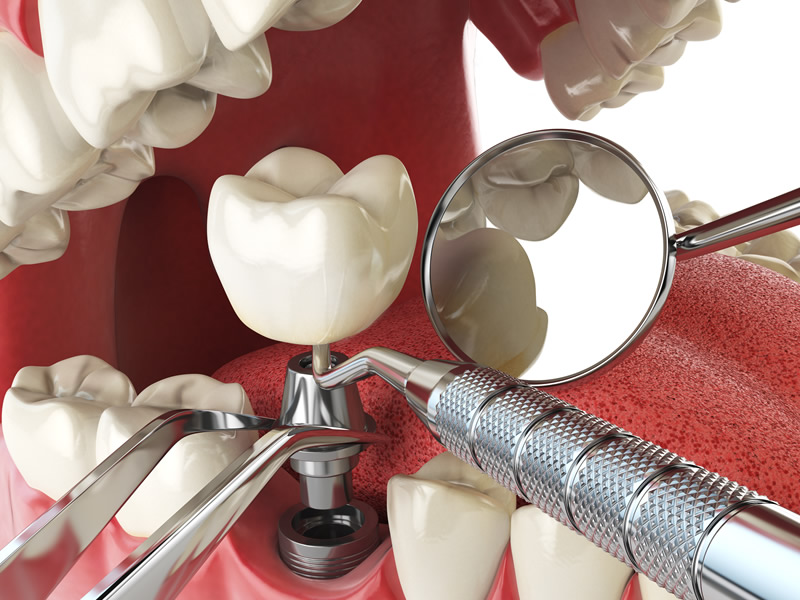 Darwenside Dental Presents: Dental Implants