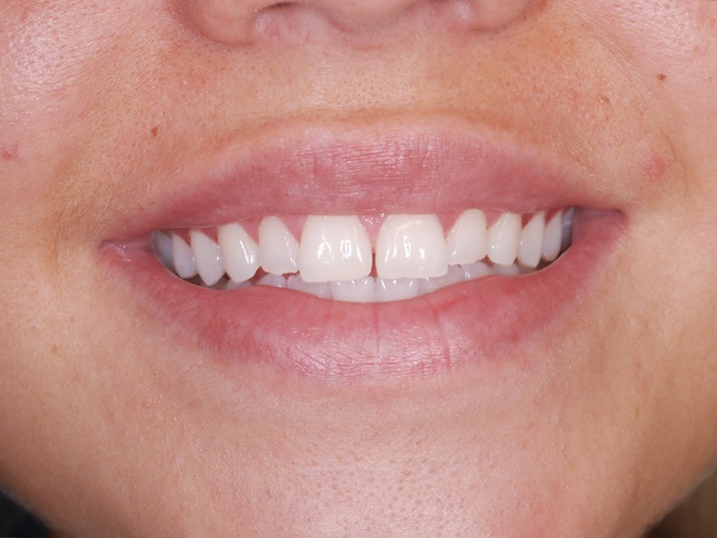 Veneers Before Veneers Before