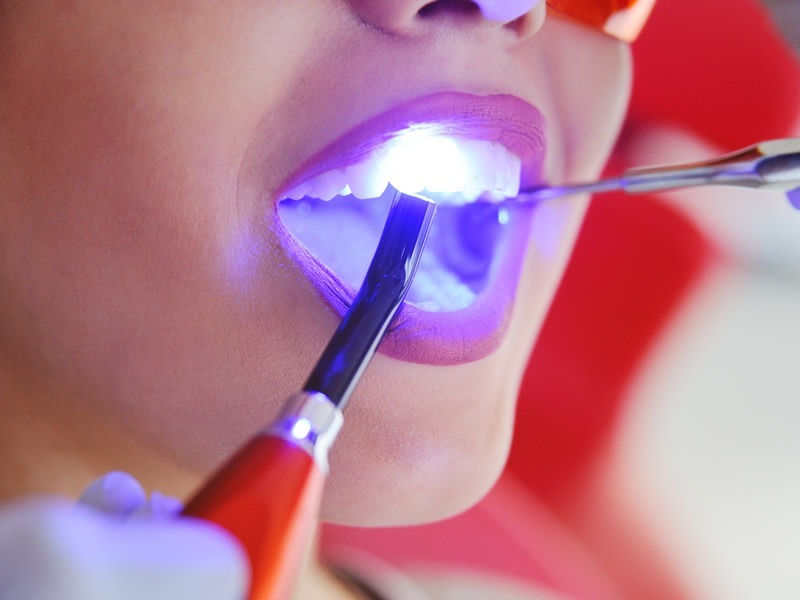 White / Tooth coloured fillings with composite bonding White / Tooth coloured fillings with composite bonding