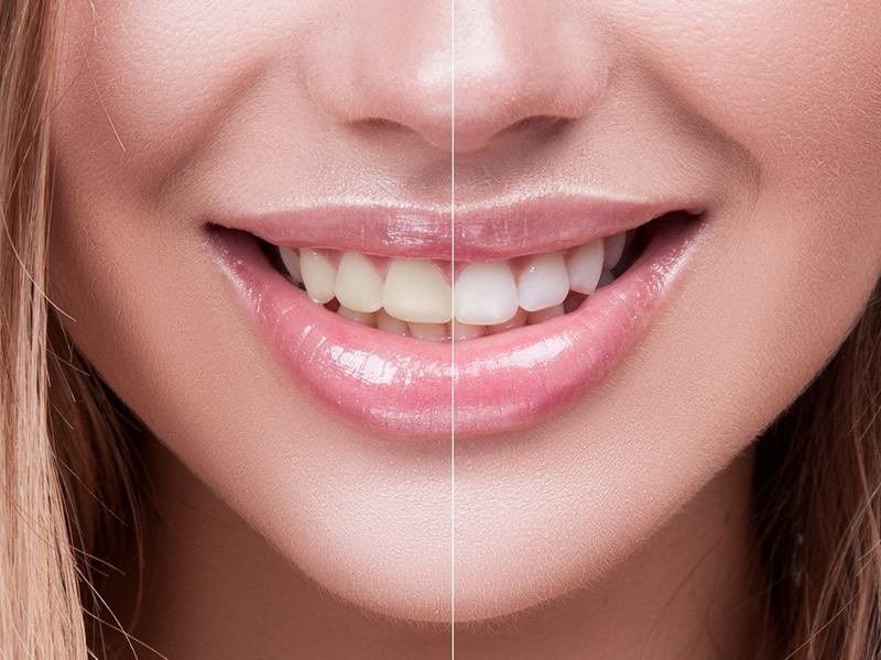 Home Whitening Home Teeth Whitening