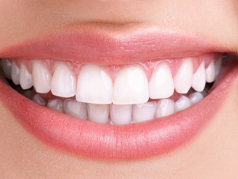 Tooth Whitening After Tooth Whitening After