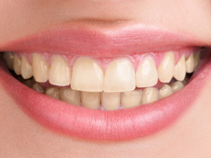 teeth-whitening-before