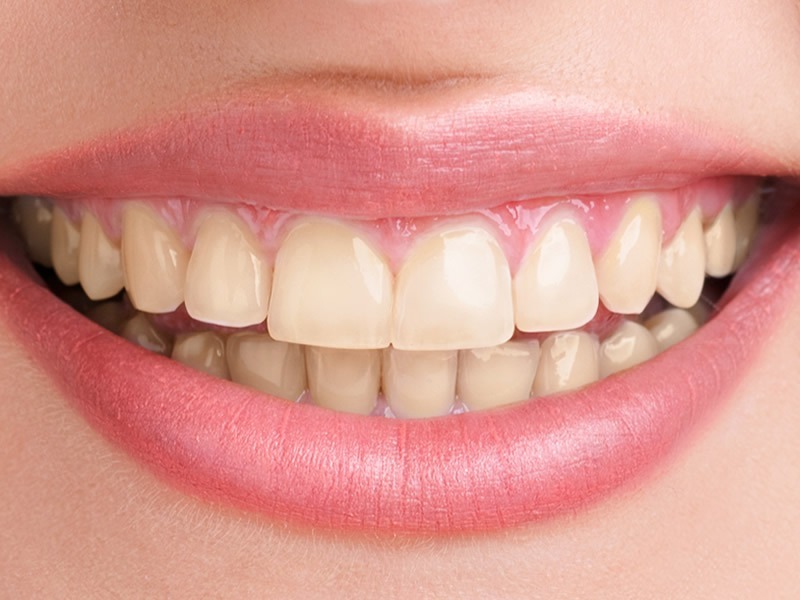 Tooth Whitening Before Tooth Whitening Before