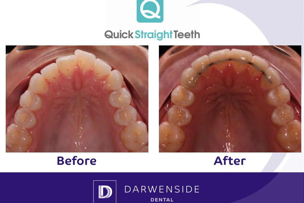 Darwenside Dental Presents: Quick Straight Teeth