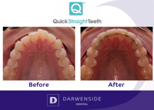 Darwenside-Quick Straight Teeth Before and After