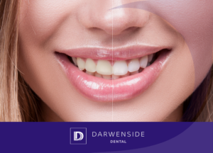 Teeth whitening darwen dentist blackburn bolton