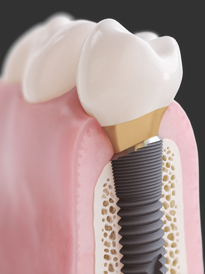 Can I have dental implants?Can I have dental implants?