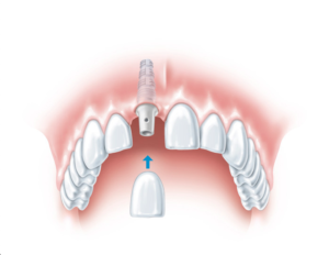 Can I have dental implants?