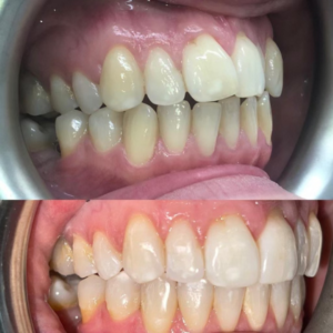 Invisalign Teeth Straightening Dental Treatment Darwen Lancashire Blackburn