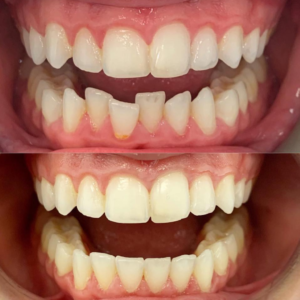 Invisalign Teeth Straightening Dental Treatment Darwen Lancashire Blackburn