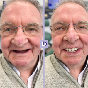 Dental Implants Treatment Implant Darwen Lancashire Blackburn