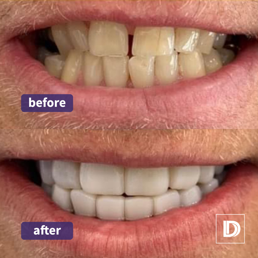 Composite Bonding Edge Bonding and Veneers Dental Treatment Implant Darwen Lancashire Blackburn