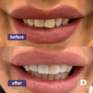 Composite Porcelain Veneers and Composite Edge Bonding Composite Bonding Edge Bonding and Veneers Dental Treatment Implant Darwen Lancashire Blackburn