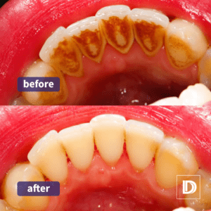 Airflow Polishing Stain Removal Dental Treatment Blackburn Darwen Lancashire