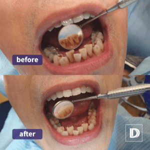 Airflow Polishing Stain Removal Dental Treatment Blackburn Darwen Lancashire
