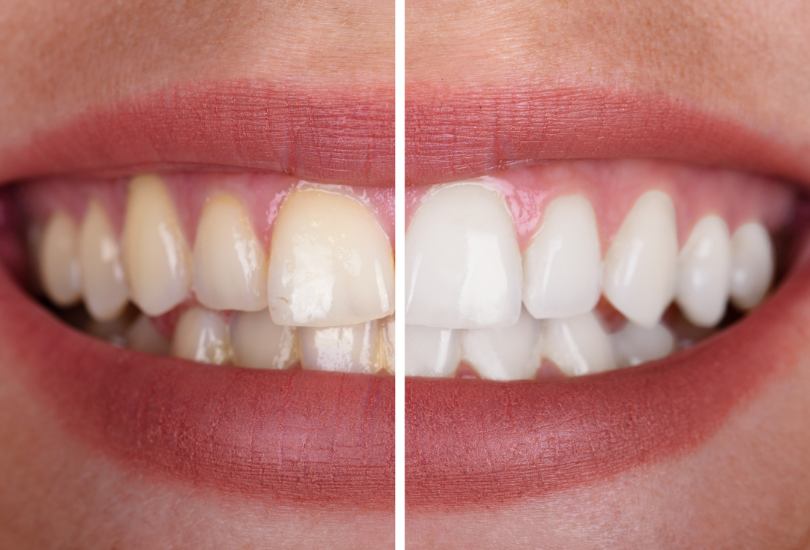 Teeth Whitening Blackburn Darwen Dentist Private