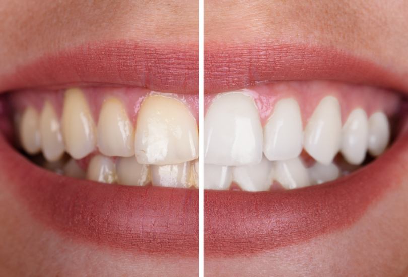 Teeth Whitening Blackburn Darwen Dentist