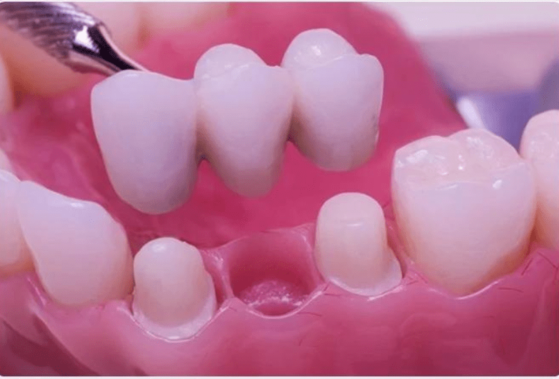 Dental Bridge Blackburn Cosmetic Dentist Darwen Accrington