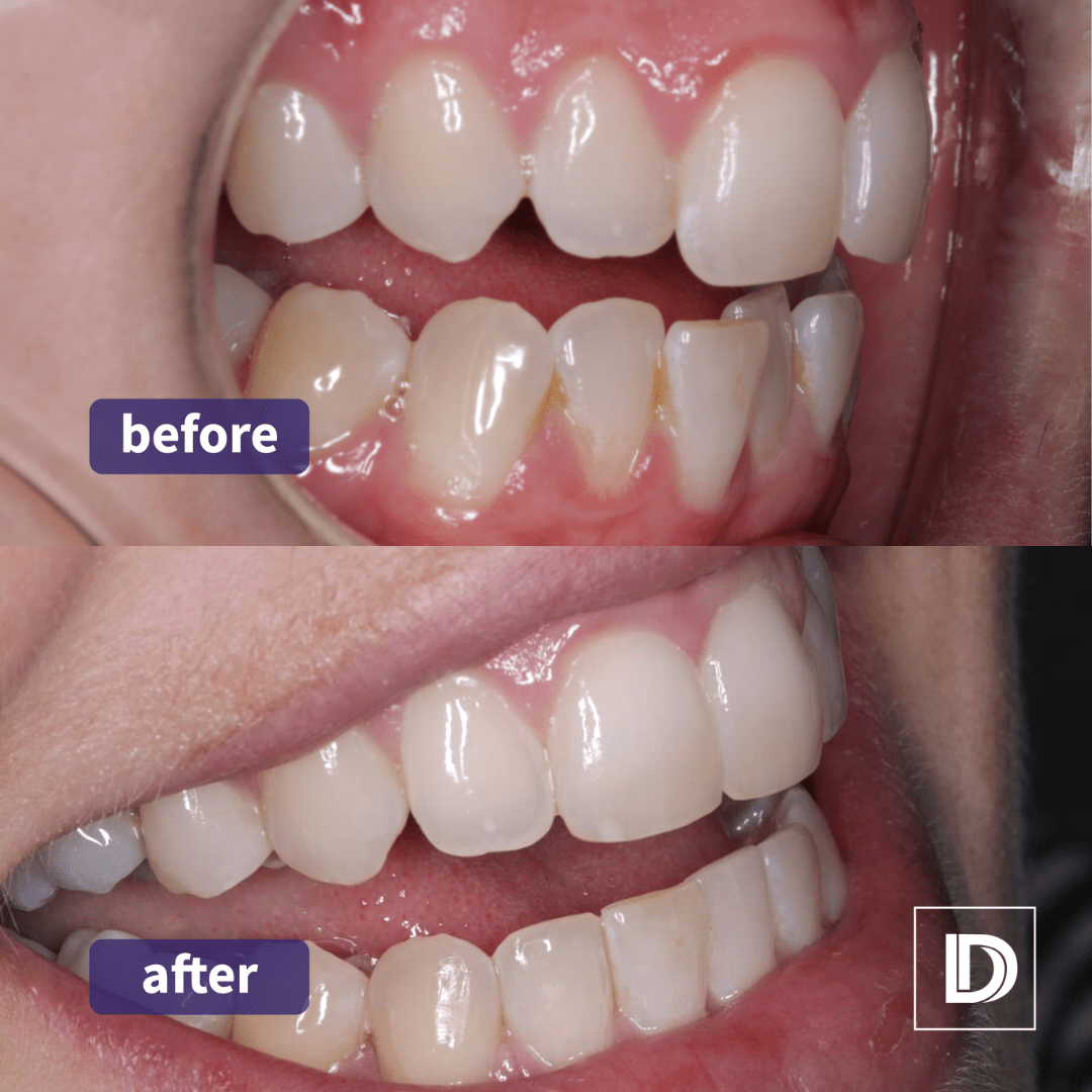 Invisalign Before & After Case Blackburn Bolton Burnley Darwen Invisalign darwen blackburn bolton
