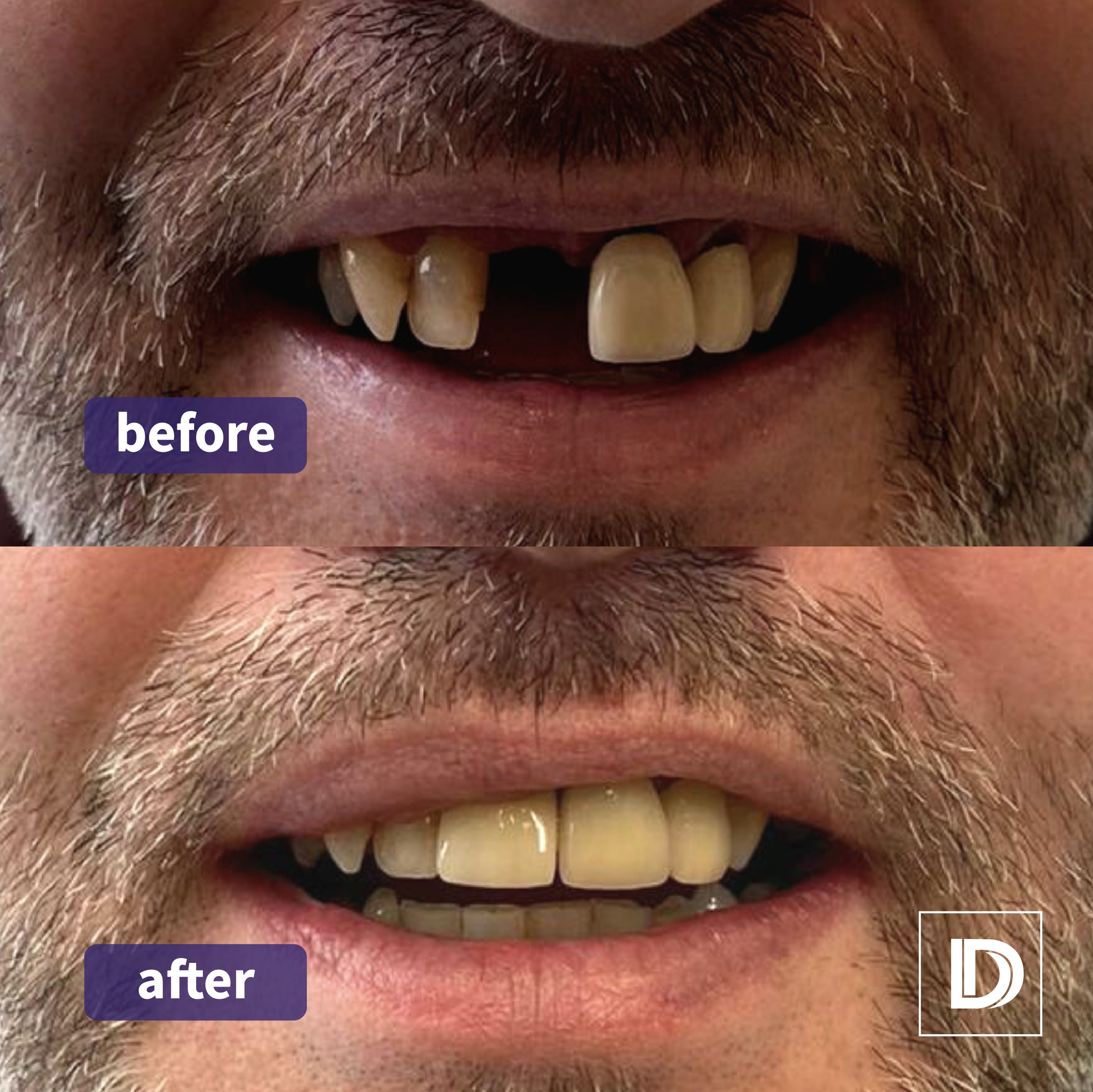 Dental Implants Missing Teeth Dentures Dentist Implant Darwen Lancashire Blackburn Bolton Burnley