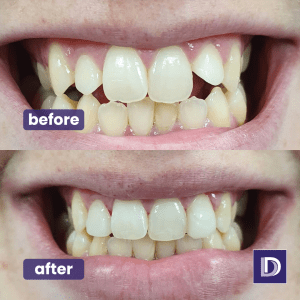 Composite Bonding Blackburn Darwen Bolton Smile Makeover