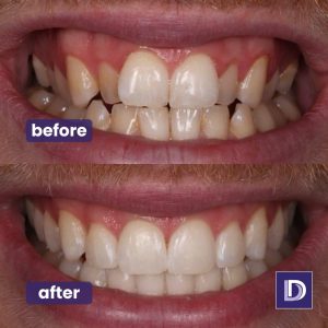 Invisalign Straight Teeth Dentist Open Day Bolton Blackburn Burnley Invisalign Straight Teeth